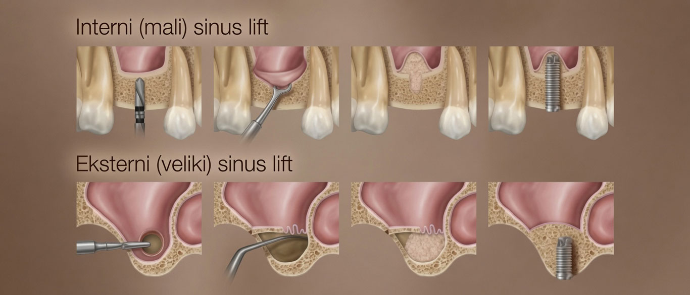 Sinus lift - podizanje dna spuštenog sinusa za ugradnju implantata, Dent'Or, Zagreb, Ravnice