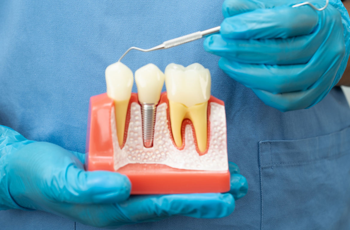 zubni implantati Zagreb, Makismir, Ravnice, ordinacija Dent'OR